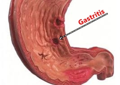 Obat Herbal Gastritis Jelly Gamat Gold-G