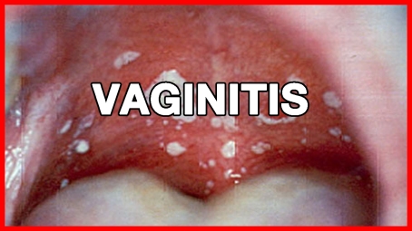 Obat Herbal Vaginitis Jelly Gamat Gold-G